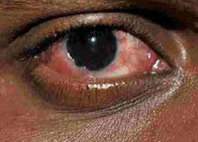 The Surge of Red Eye Disease in Kenya's Coast Region