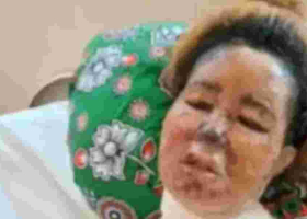 Mombasa Woman Fights for Her Life After Boyfriend Scalds Her Face with Boiling Oil 