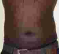 Number of Kenyan Men Seeking Belly Fat Removal Grow