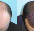 Hair Transplant Clinic Opened in Nairobi