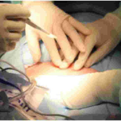 Catholic Priest Undergoes First Successful Heart Valve Transplant in Kenya