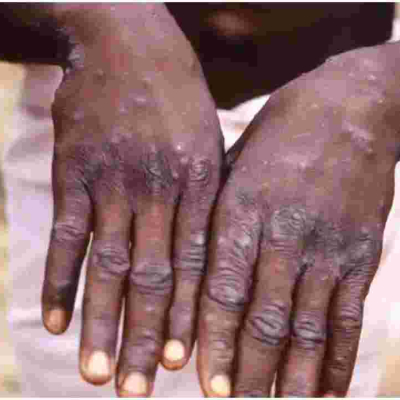 Health Ministry Says No Case of Monkeypox Recorded in Kenya