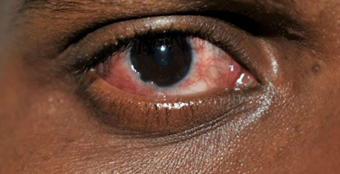 An Image of a Red Eye With Conjunctivitis The Surge of Red Eye Disease in Kenya's Coast Region