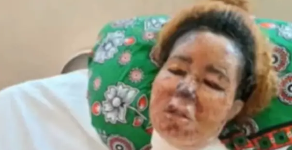 Deborah Mombasa Woman Fights for Her Life After Boyfriend Scalds Her Face with Boiling Oil