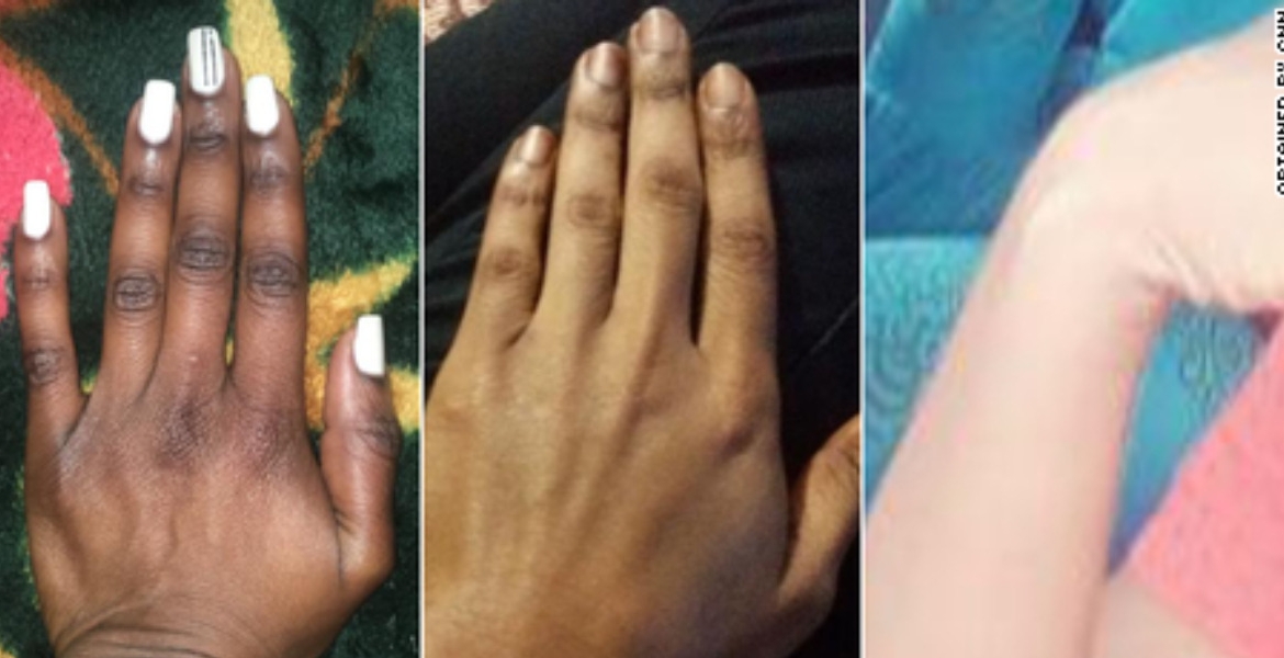 Skin Bleaching Kenya Battles Skin Bleaching Trend Despite Ban on 400 Dangerous Cosmetics
