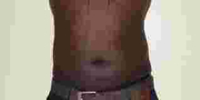 Number of Kenyan Men Seeking Belly Fat Removal Grow