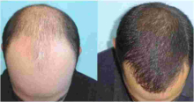 Hair Transplant Clinic Opened in Nairobi