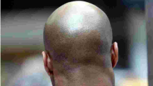  British Court Rules Calling a Man 'Bald' is Sexual Harassment